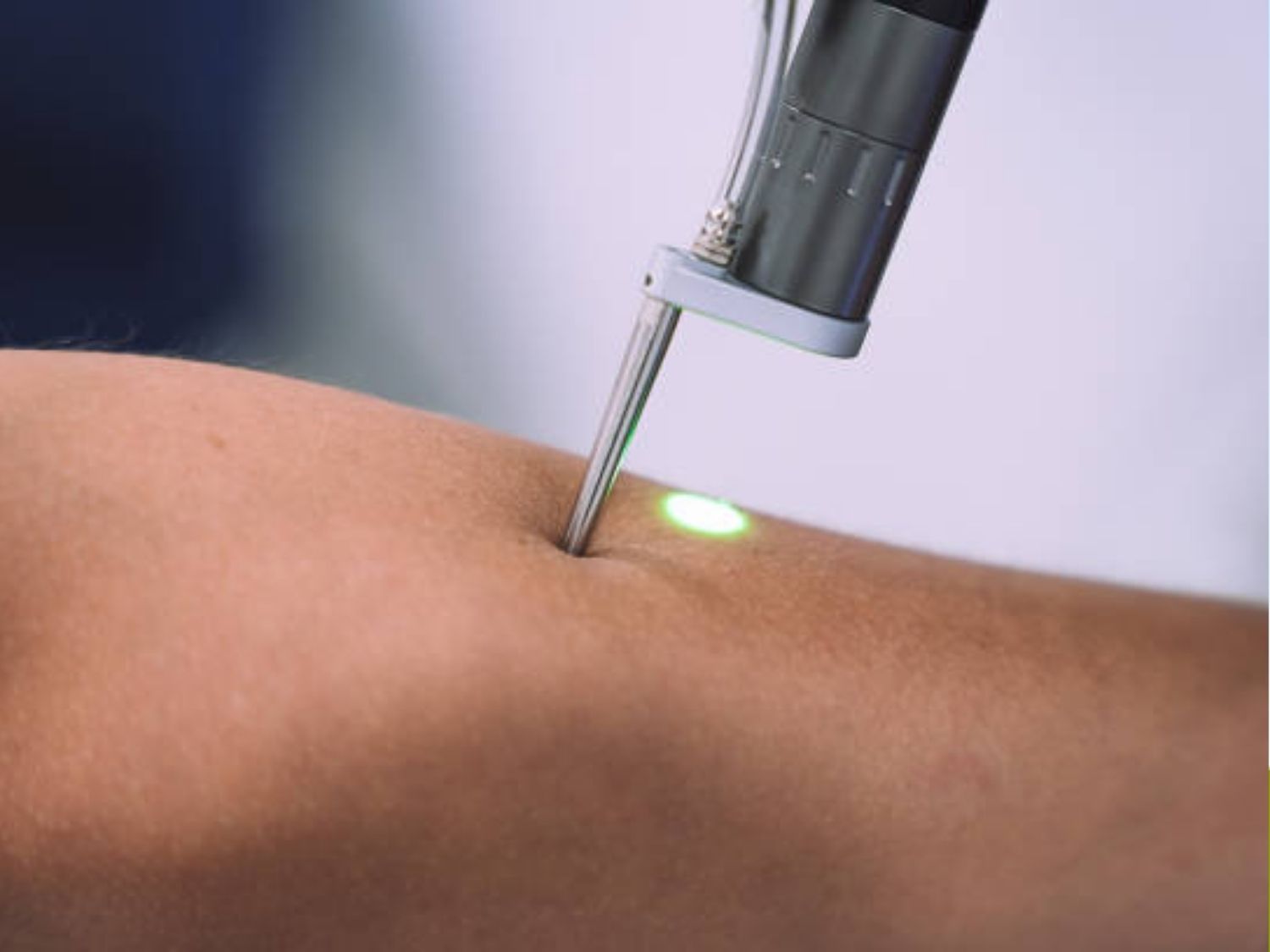 Laser Pico Discovery nghiền nát hạt sắc tố melanin tích tụ dưới da