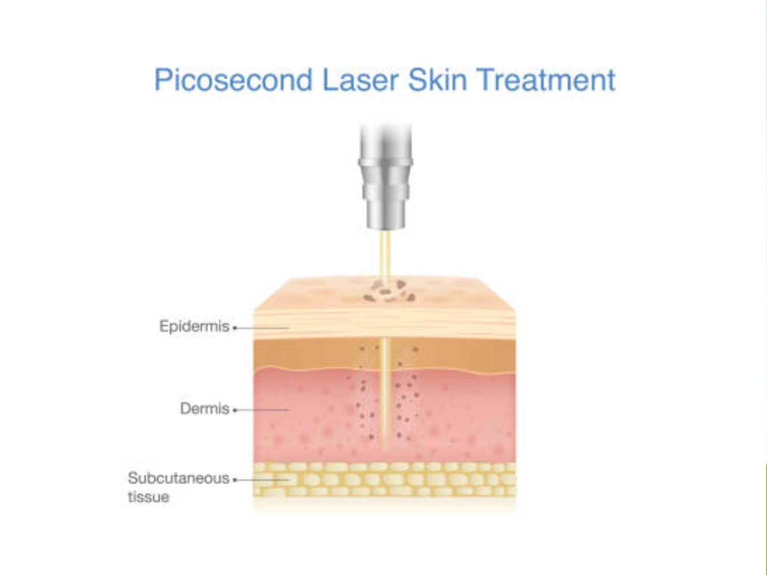 ảnh minh họa độ tác động của Pico laser trên làn da