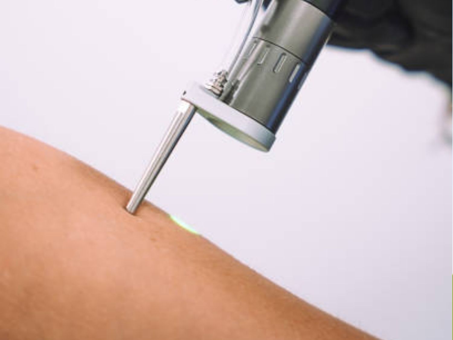 Pico Discovery phát ra chùm tia bước sóng siêu ngắn, tán nhỏ melanin thành những mảnh siêu mịn