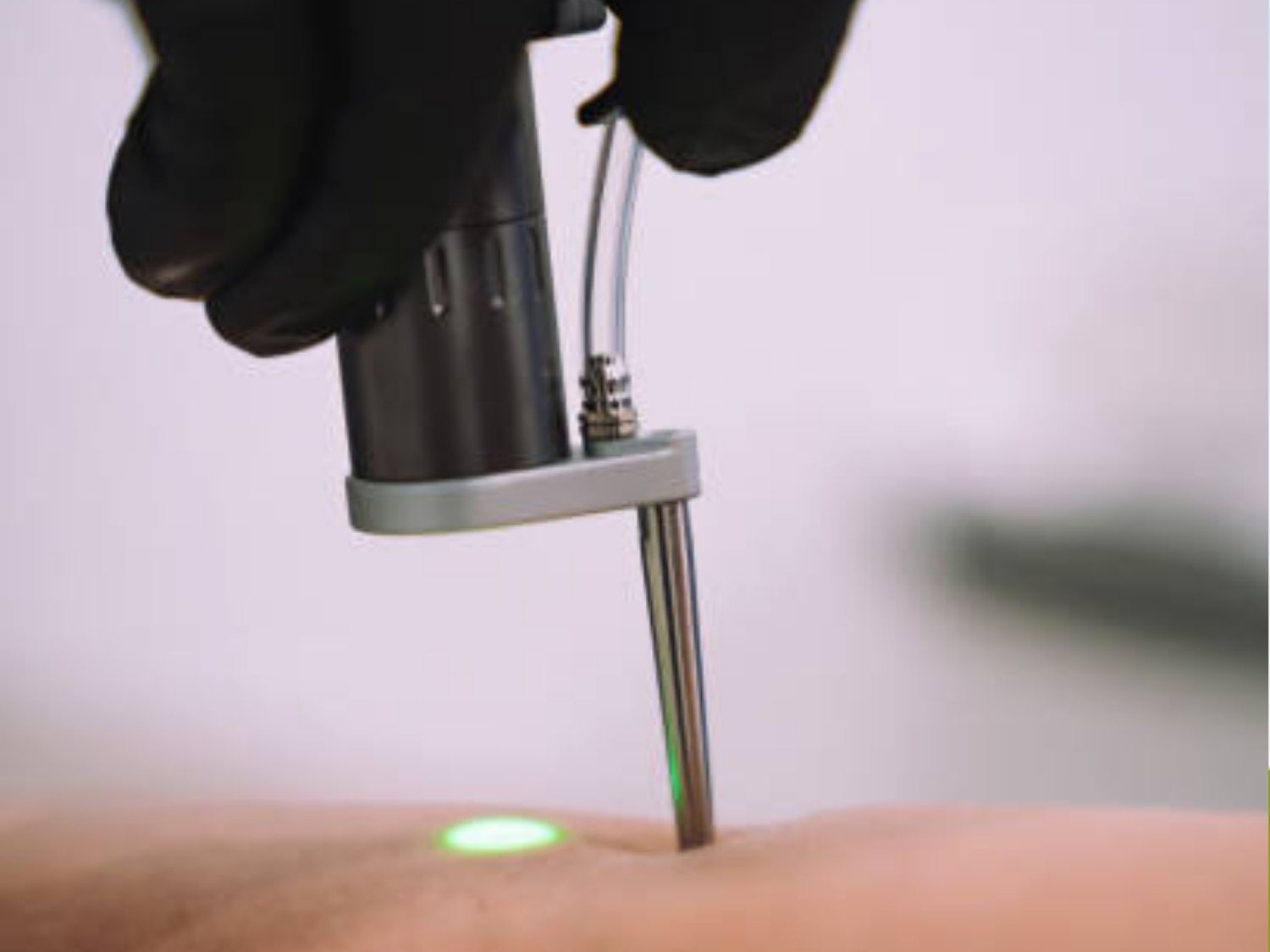 Laser Pico Discovery không bào mòn da