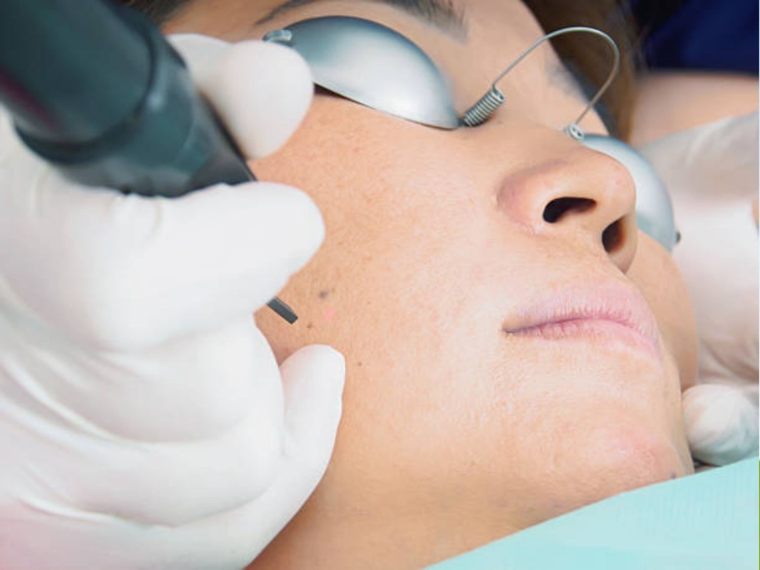 Laser Picosure Pro biến đổi năng lượng quang thành áp lực để băm nhỏ các cụm melanin