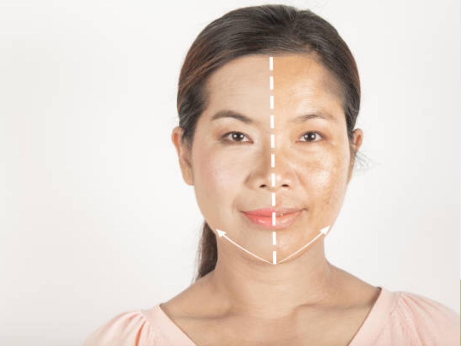 kết quả thấy nhanh sau vài buổi điều trị Picosure Pro