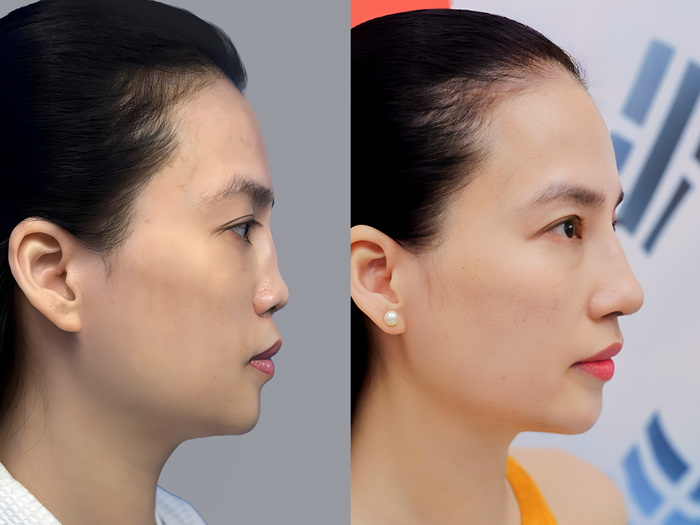 Khách Thu Hà trước và sau khi sửa mũi hỏng, dáng mũi cân đối toàn diện