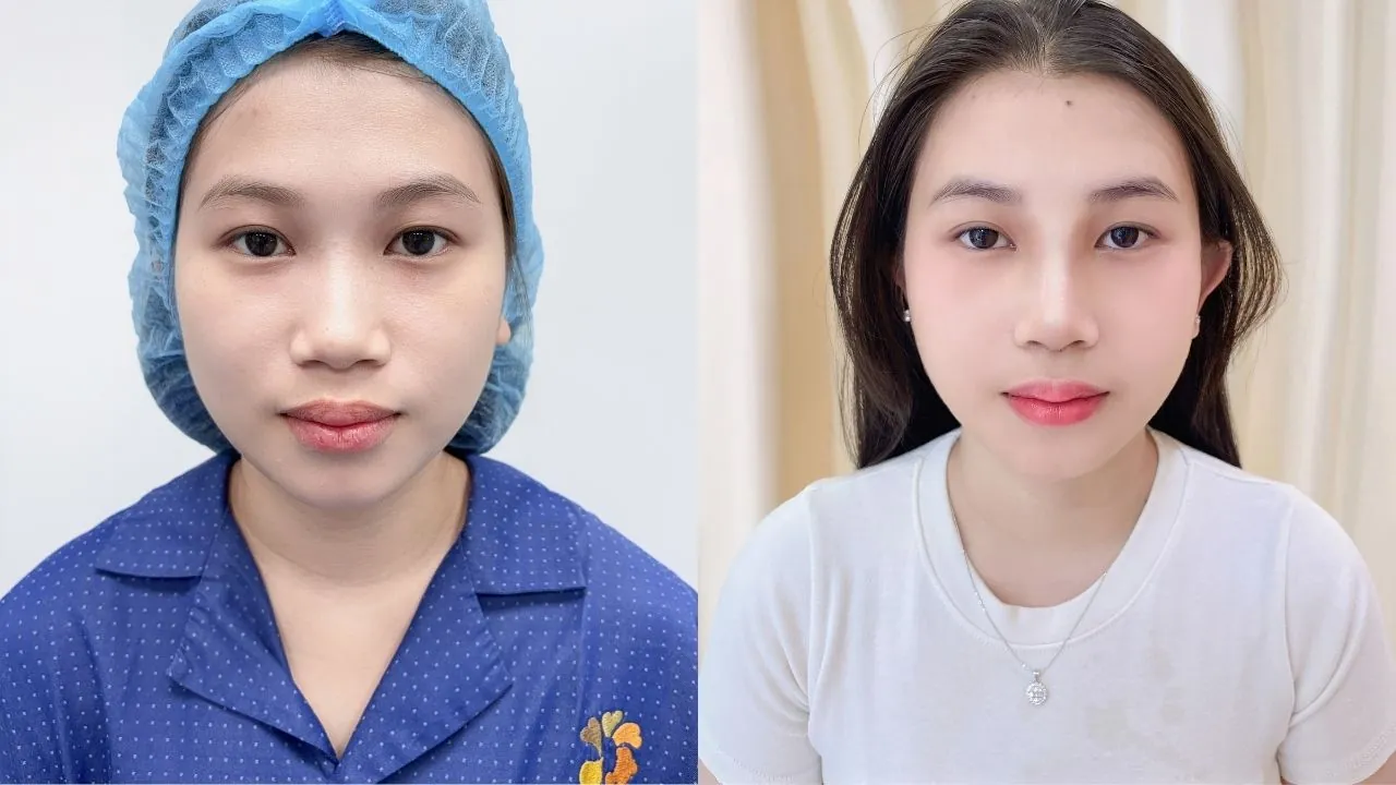 Ảnh so sánh trước và sau khi nâng mũi tại Kangnam của khách Thu Trang