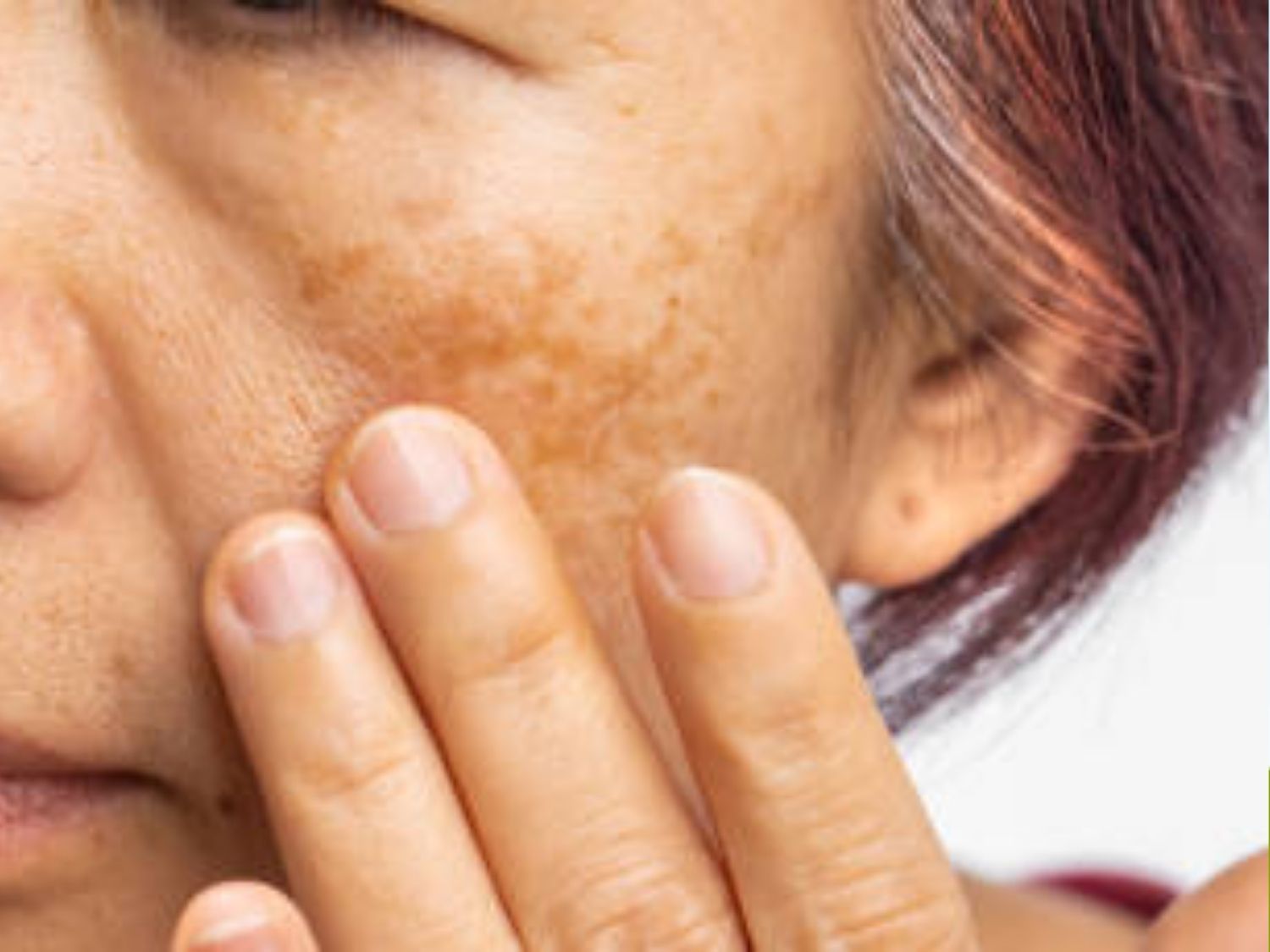 da bị tái phát nám do chăm sóc sai cách