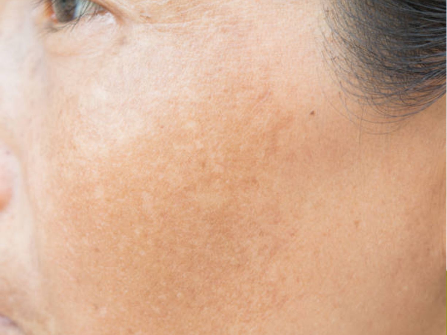 Công nghệ Laser Pico Discovery trị được da nám