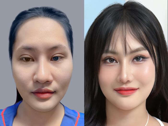 ảnh trước sau của khách hạ gò má, thời gian hồi phục nhanh sau 2 tuần