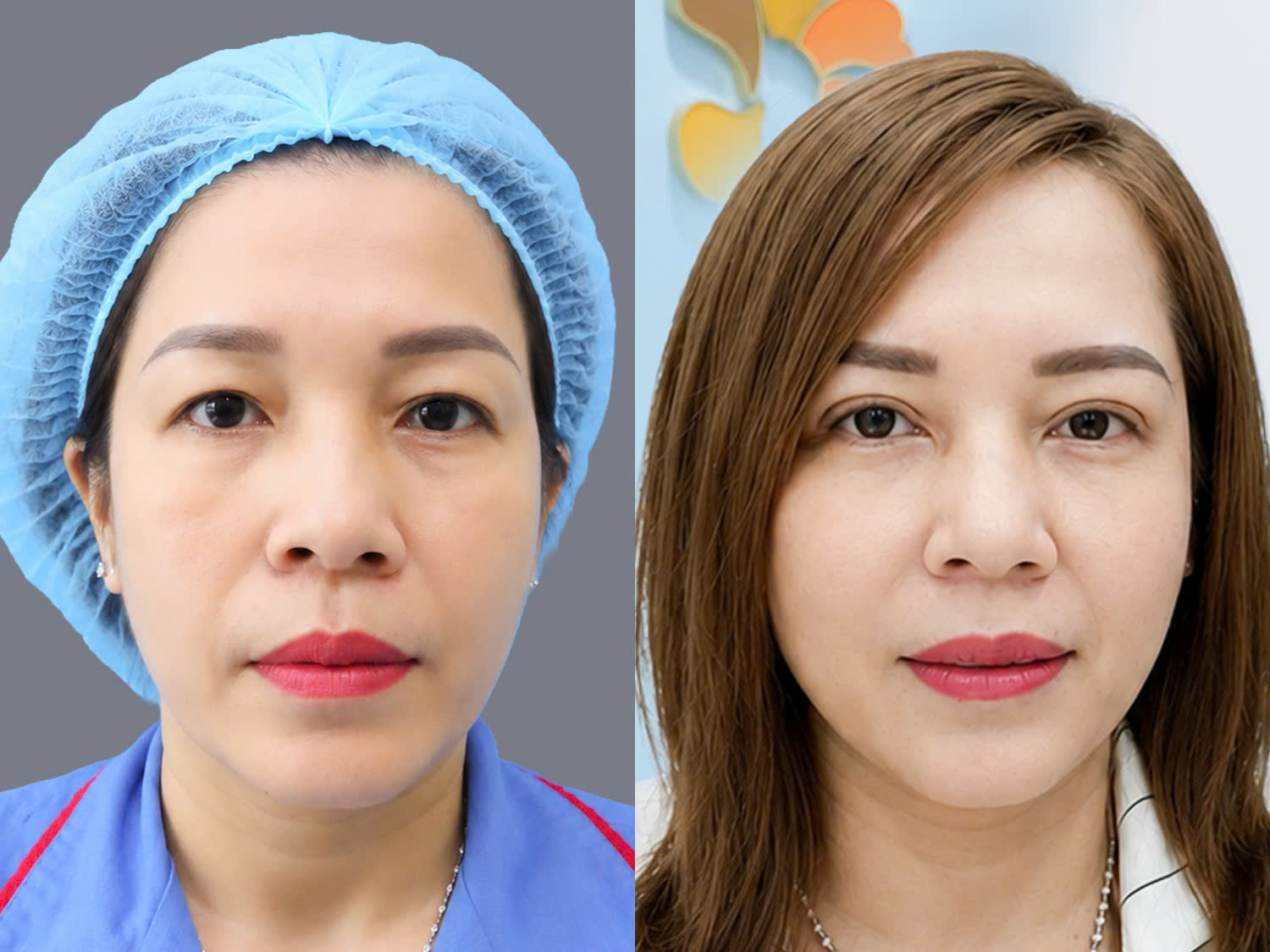Xử lý da chùng mí mắt giúp đôi mắt tươi trẻ, tự nhiên