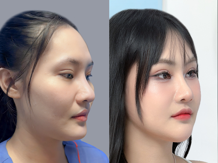 Phẫu thuật hạ gò má tái cấu trúc tầng giữa mặt bằng cách can thiệp phẫu thuật vào xương gò má và thân xương gò má, ảnh khách hạ gò má