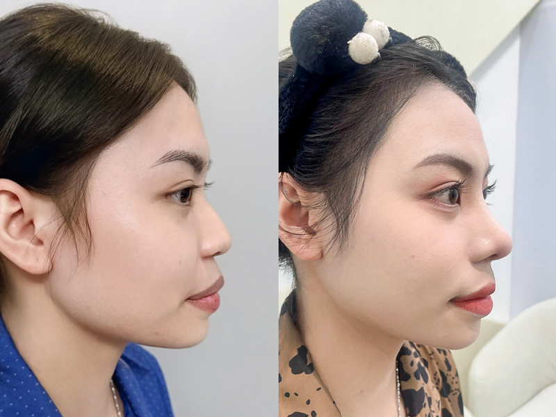 ảnh so sánh trước và sau nâng mũi của khách hàng