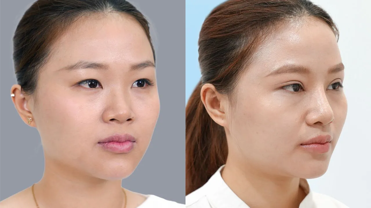 ảnh so sánh trước sau của Khách hàng Diệu hiền thực hiện nâng mũi + cắt mí tại Kangnam