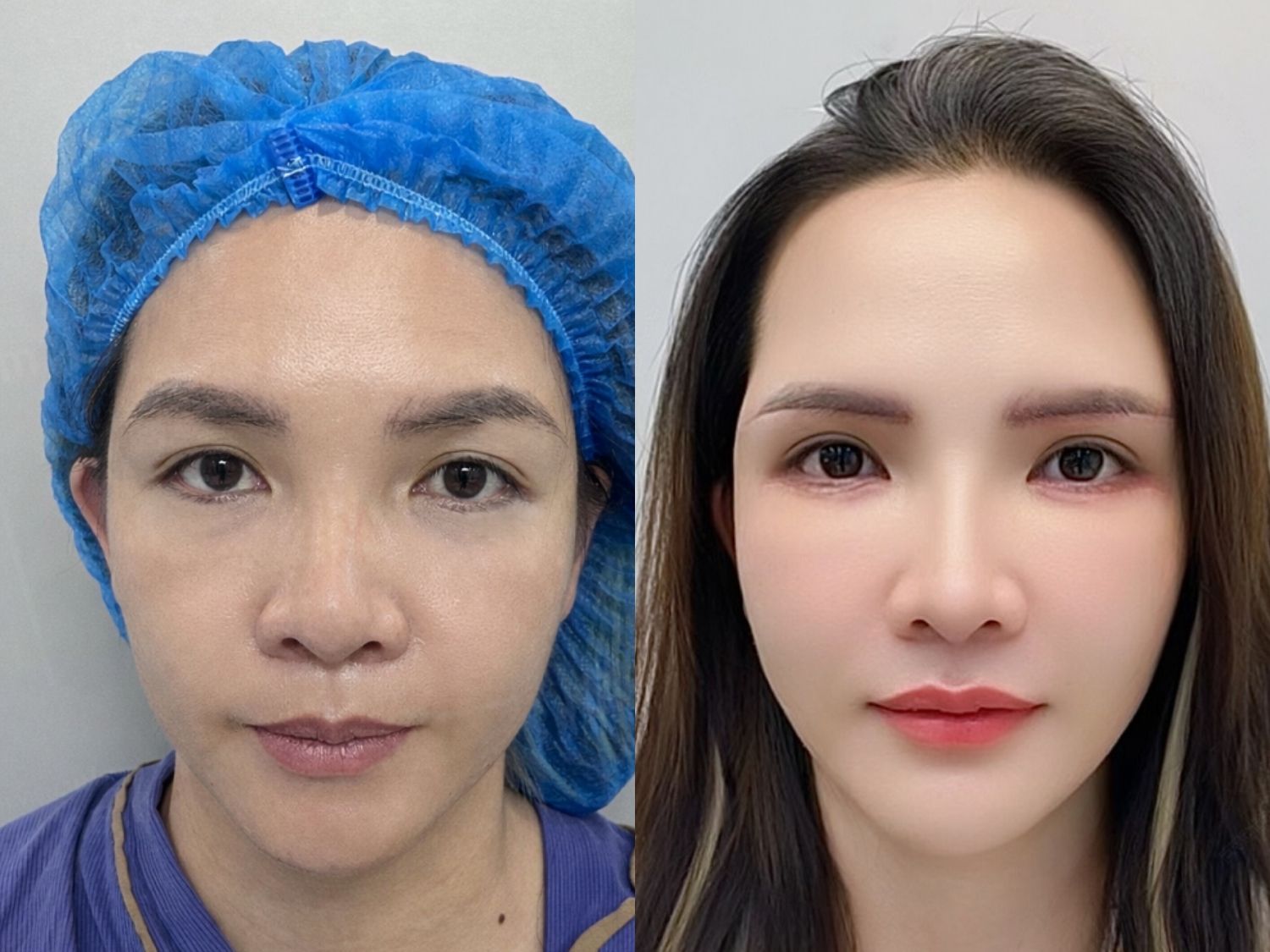 Chị Ngọc Vân trước và sau khi lấy bọng mỡ mí mắt