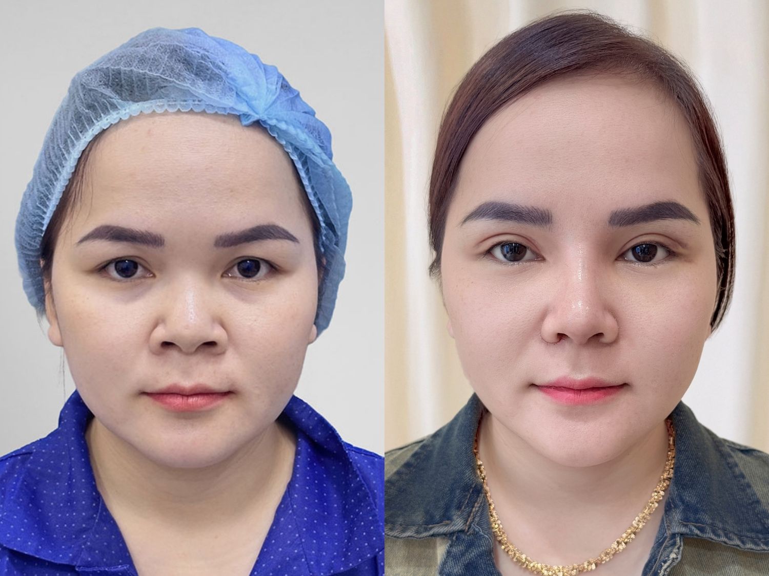 Như Ý sở hữu đôi mắt to tròn, khắc phục tình trạng sụp mí