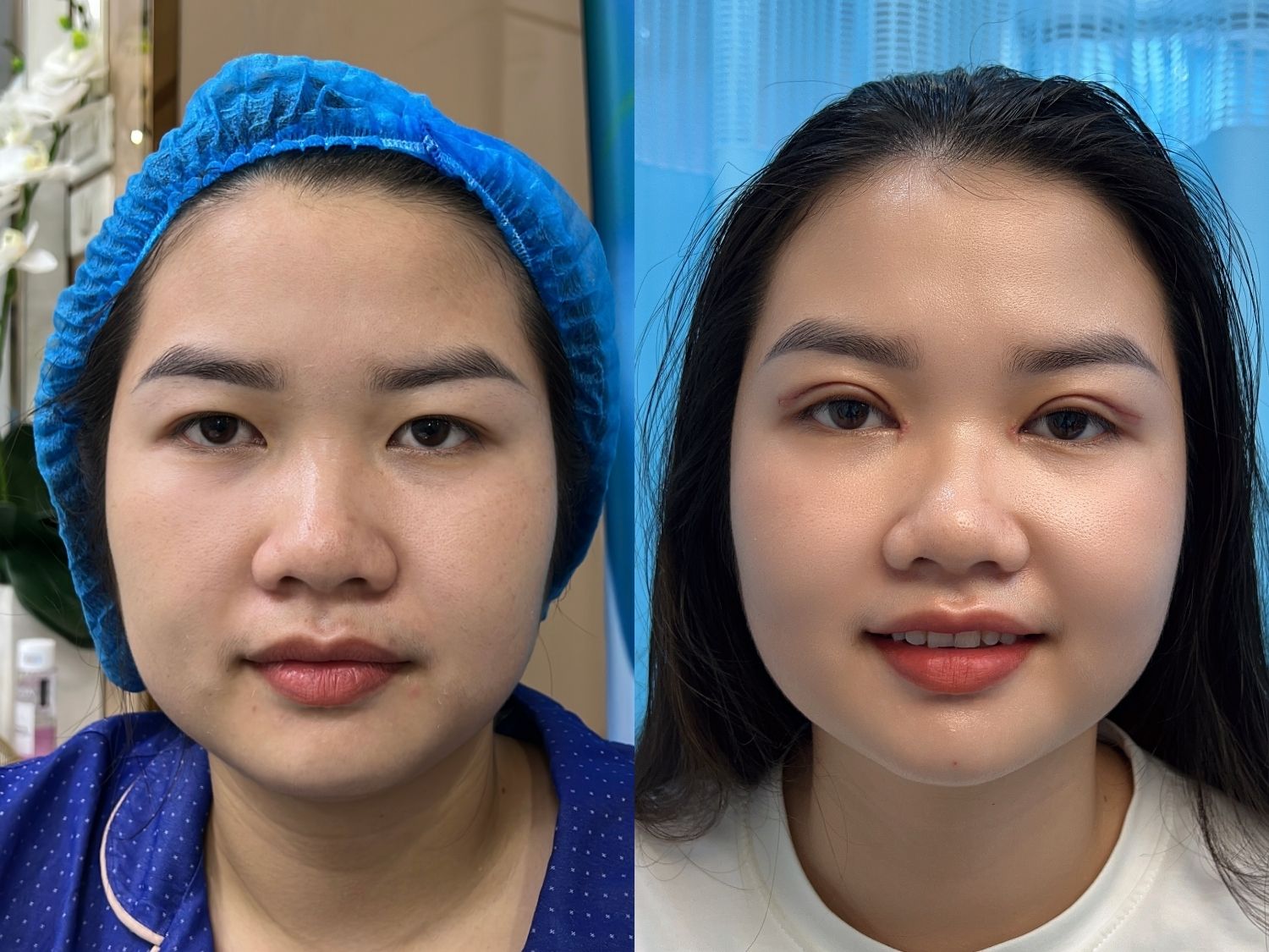 Chị Thúy Vân khắc phục được tình trạng da chùng mí mắt, giúp đôi mắt to tròn và có nếp mí tự nhiên