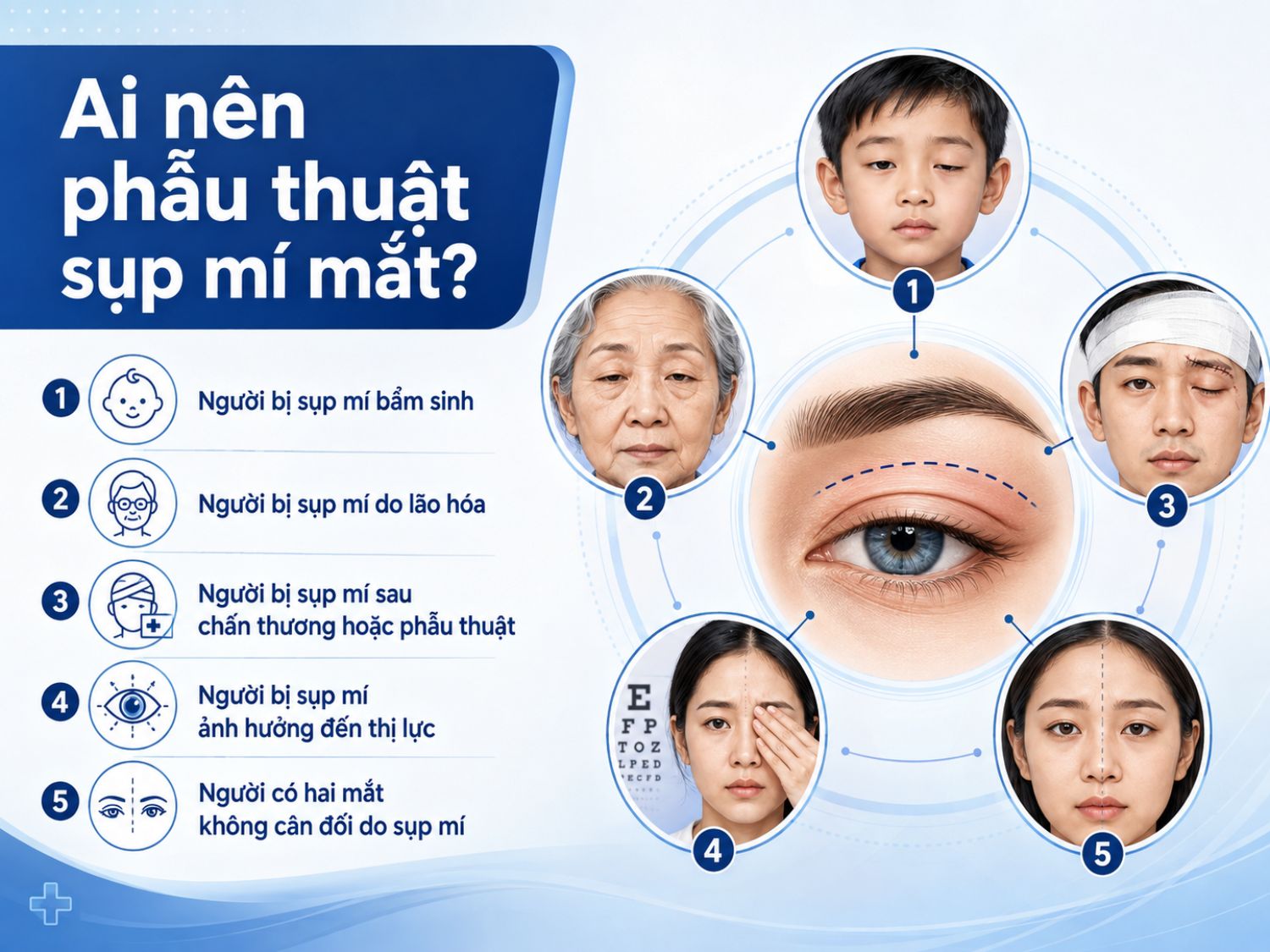 Phẫu thuật sụp mí thường phù hợp với người bị sụp mí bẩm sinh, sụp mí do lão hóa, sau chấn thương hoặc phẫu thuật, người bị ảnh hưởng thị lực và trường hợp hai mắt mất cân đối do sụp mí.