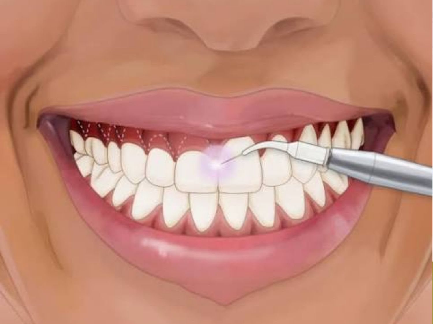 Cắt nướu tạo hình thẩm mỹ chữa cười hở lợi, ảnh mô phỏng
