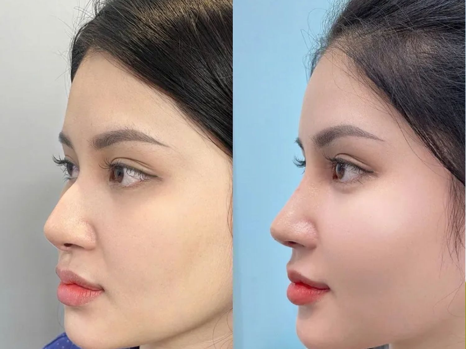 Khách hàng Hương Ly trước và sau khi sửa lại mũi