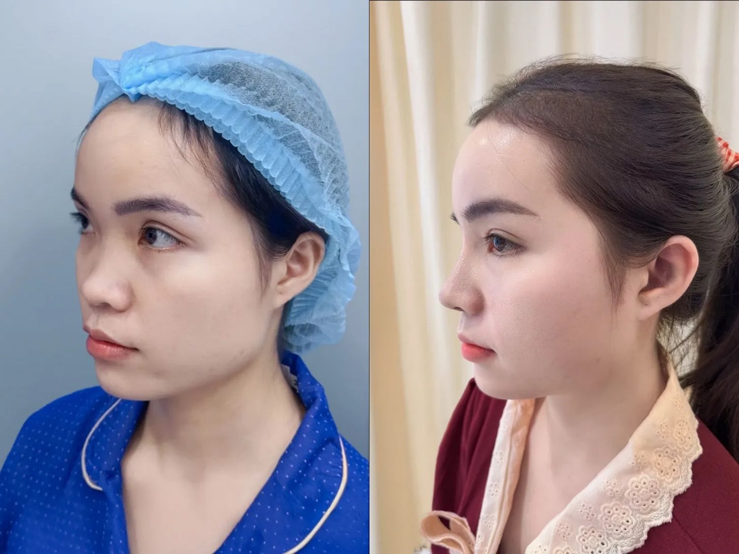 ảnh khách hàng trước và sau khi nâng mũi, dáng mũi tự nhiên, ổn định