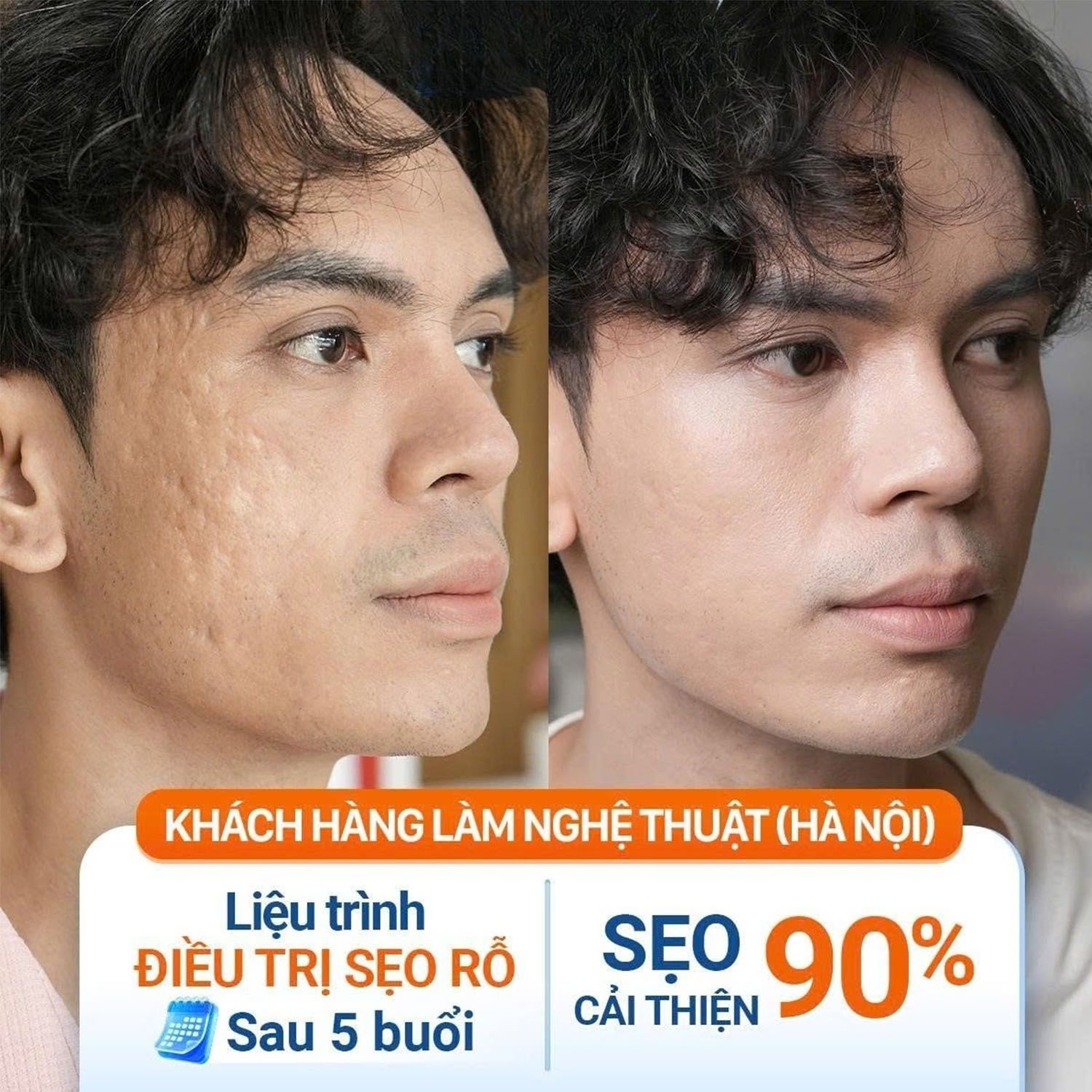 Phú bị sẹo rỗ chân vuông và sẹo lượn sóng lâu năm. Sau liệu trình, các vùng sẹo lõm được cải thiện đáng kể, bề mặt da phẳng mịn và đều màu hơn