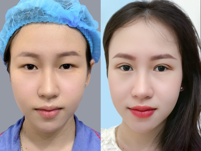 Để cải thiện mắt nhỏ bác sĩ phải có nhiều năm kinh nghiệm, có con mắt thẩm mỹ tinh tế