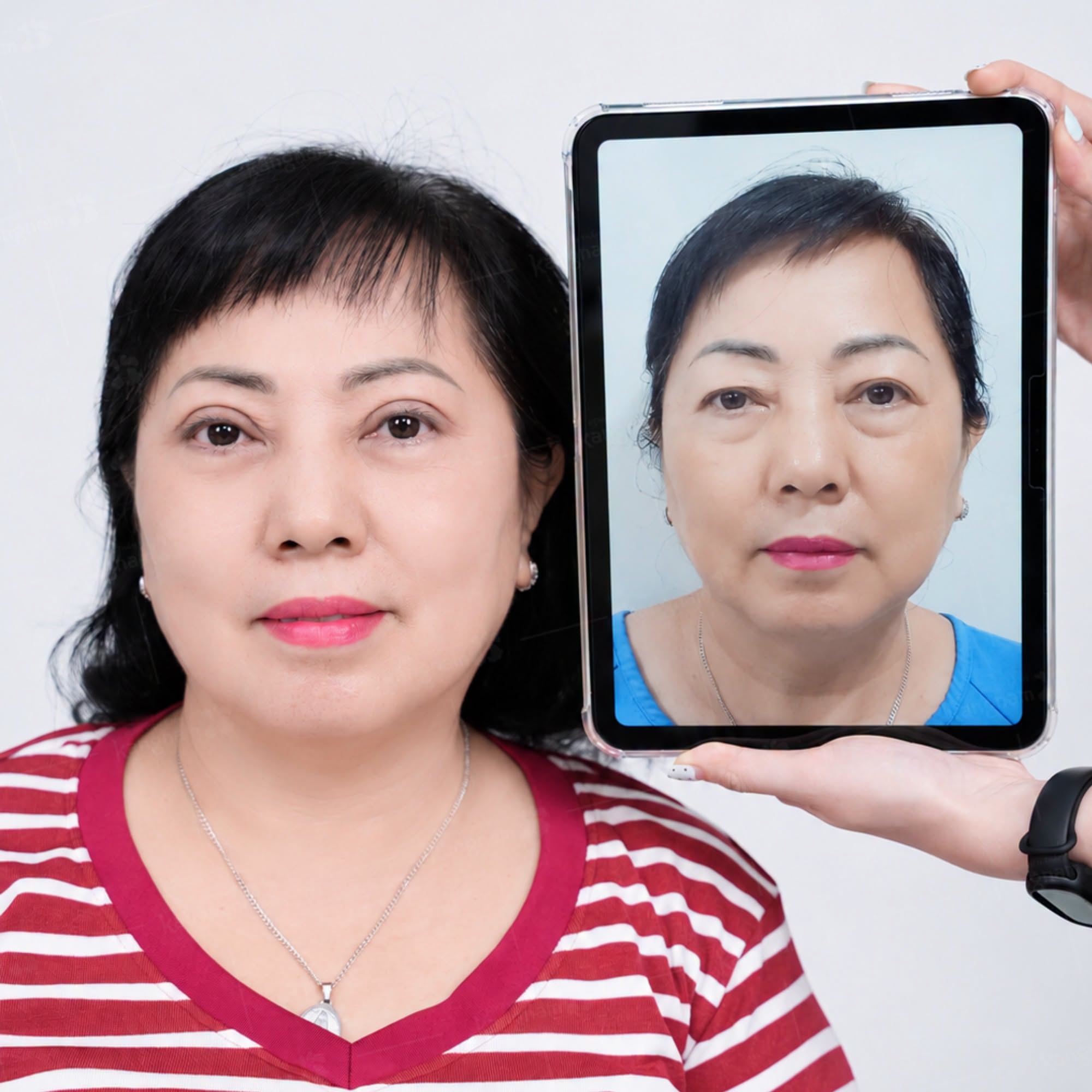 Khách hàng lớn tuổi nên lựa chọn địa chỉ cắt mí có đội ngũ bác sĩ giỏi chuyên môn, ứng dụng kỹ thuật cắt mí hiện đại