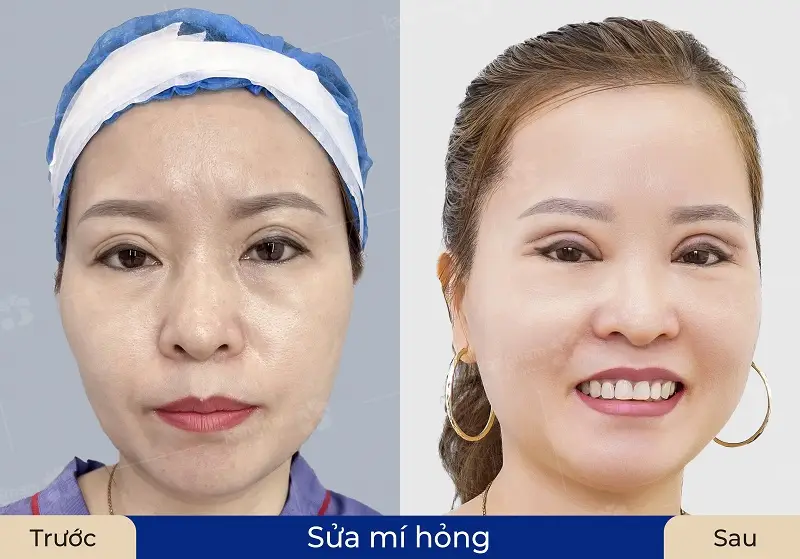 Khách hàng có mí lỗi hỏng được khắc phục hiệu quả tại Kangnam