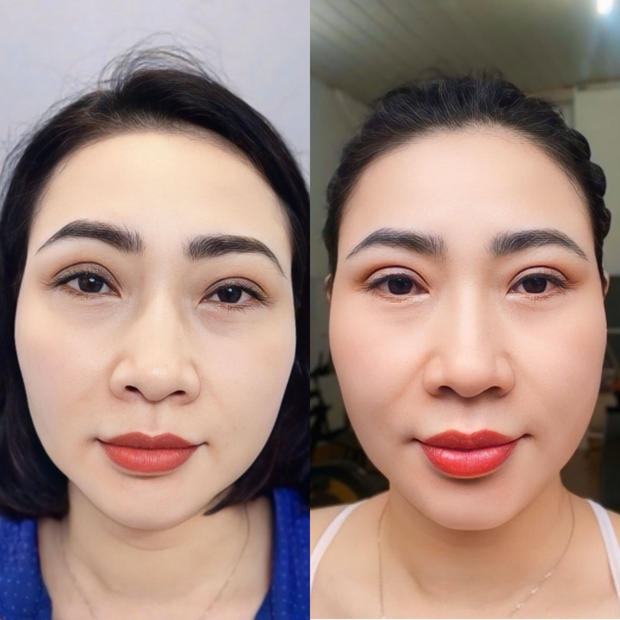 Chị Quỳnh Mai sở hữu đôi mắt cân đối, tự nhiên sau khi cắt mí