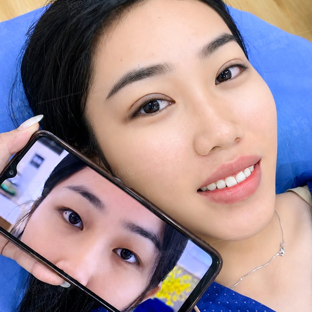 Hình ảnh khách hàng sau cắt mí, nếp mí rõ và cân đối hơn so với hình ảnh trước khi thực hiện trên điện thoại.
