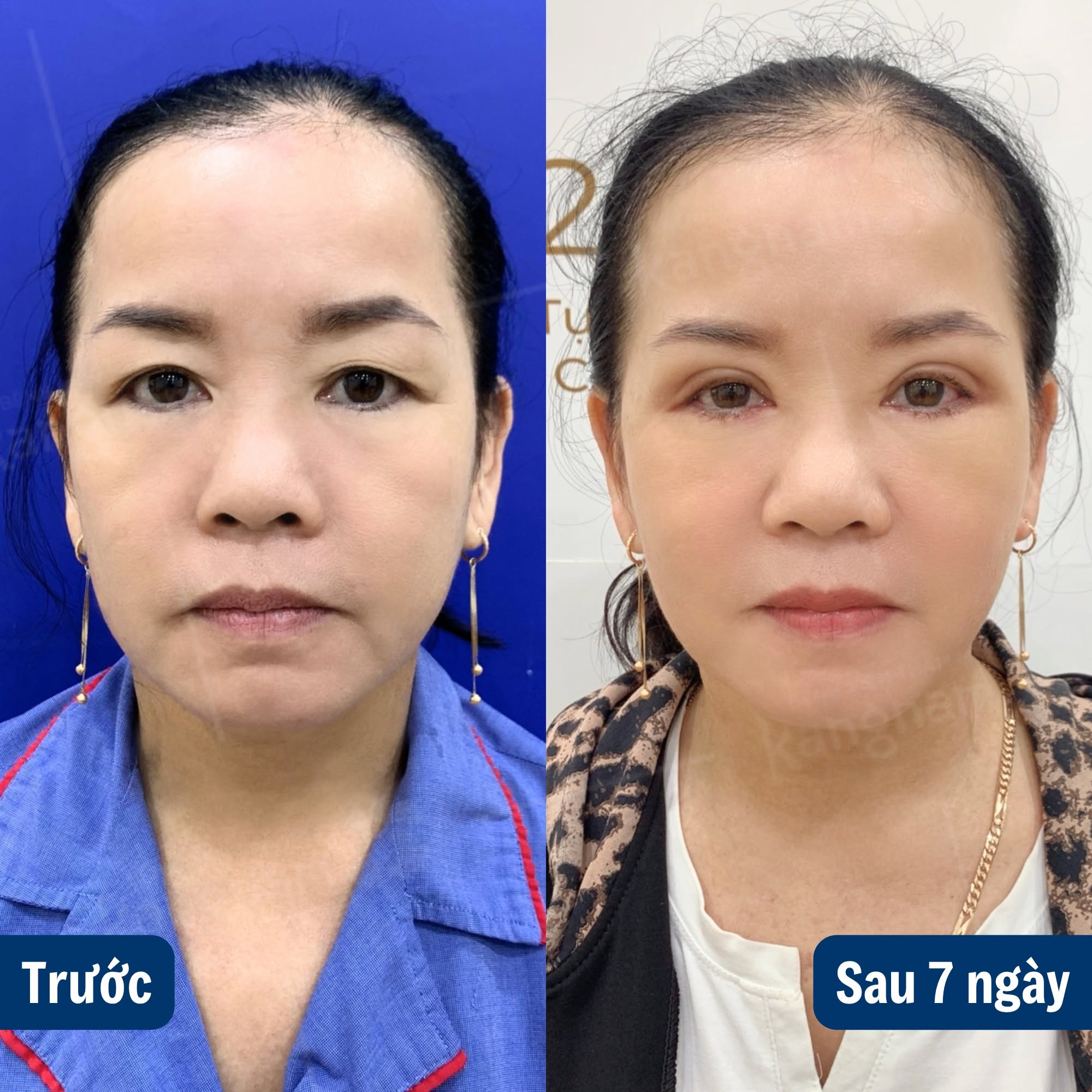 Khách hàng u40 thực hiện cắt mí tại Kangnam