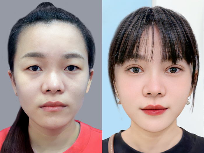 khách thực hiện nâng mũi, cắt mí cùng lúc