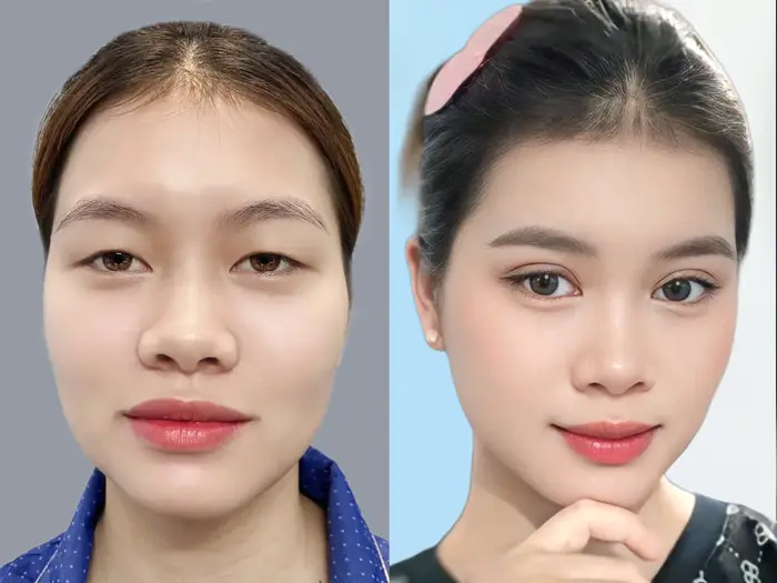 Để mí mắt phục hồi mới nên đeo kính áp tròng sau khi cắt mí