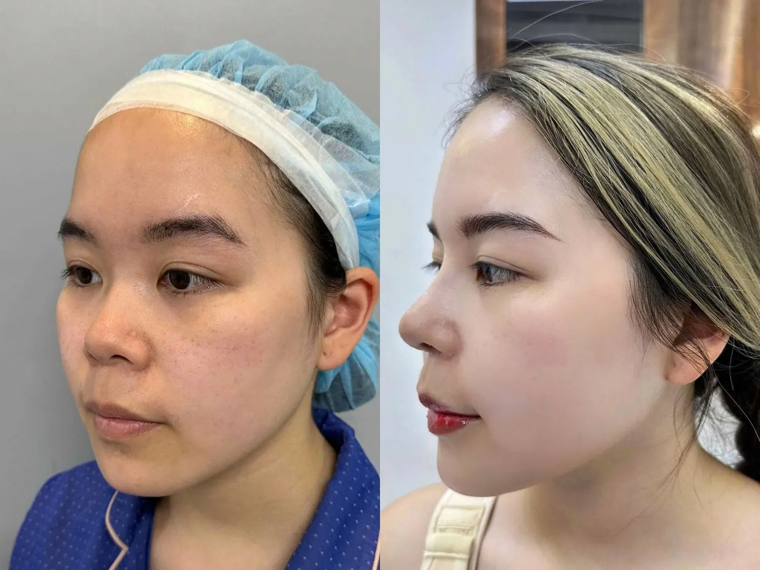 khách hàng thực hiện Nâng mũi không đau 6D có quá trình phẫu thuật nhẹ nhàng, hồi phục ổn định