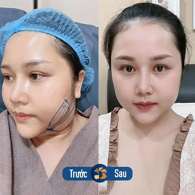 Nọng cằm được xử lý triệt để sau hút mỡ