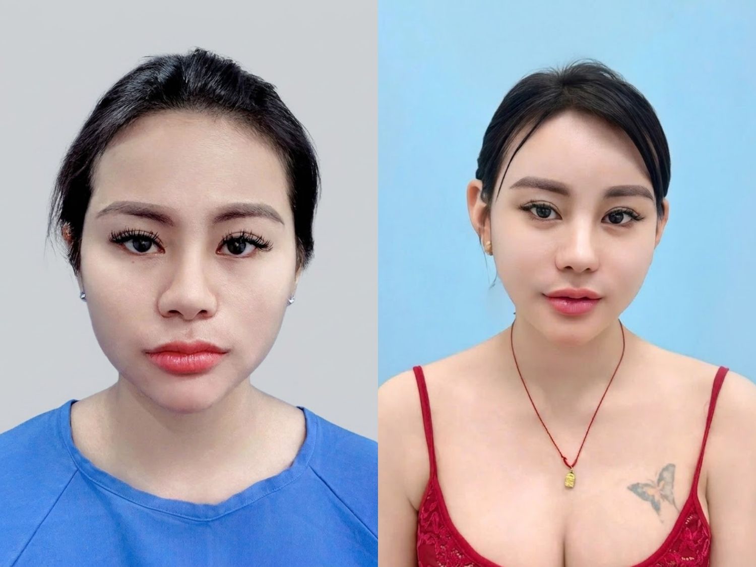 ảnh trước sau của khách hạ gò má, sau hạ gò má gương mặt không chảy xệ