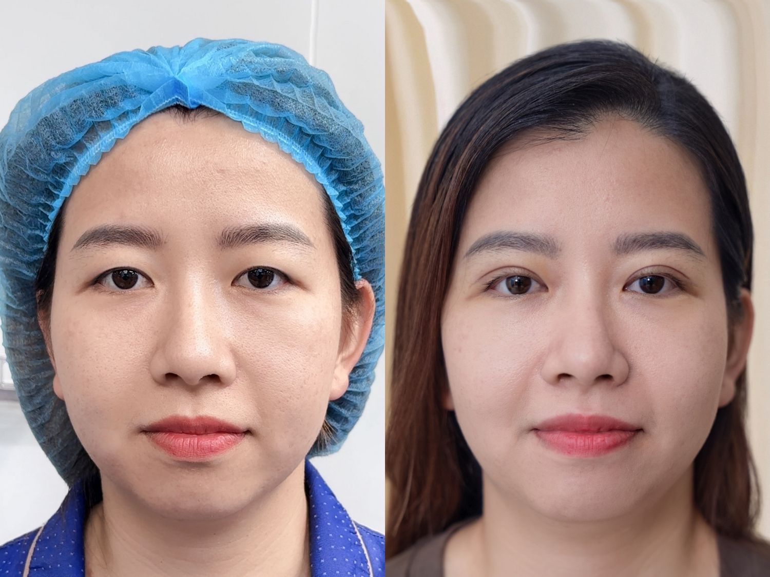 Hồng Thủy sở hữu đôi mắt 2 mí cân đôi sau cắt mí tại Kangnam Sài Gòn