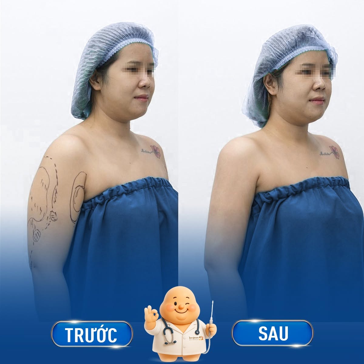 Hút mỡ bắp tay với bác sĩ nhiều kinh nghiệm sẽ giúp tránh tình trạng lồi lõm, mỡ hút không đều