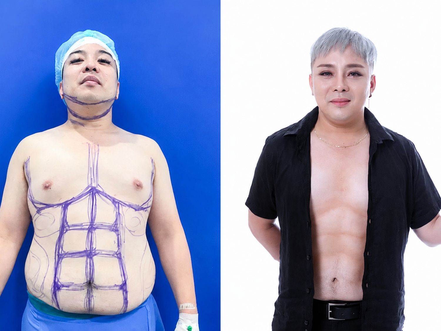 Hút mỡ bụng, tạo 6 múi nam tính và thu hút