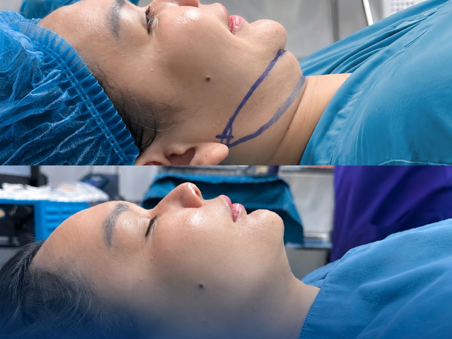 Quá trình hút mỡ nọng cằm diễn ra nhanh chóng và hiệu quả
