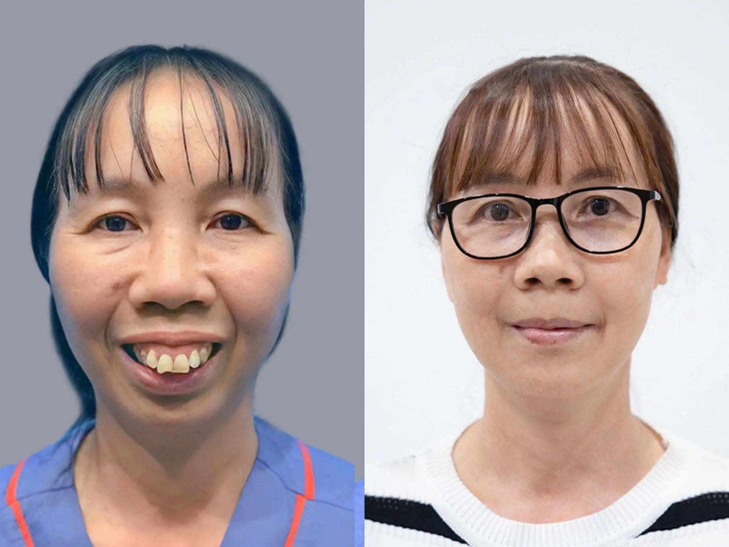 Cô Vũ Thị Thảo (50 tuổi) trước và sau khi chỉnh hàm hô chữa cười hở lợi