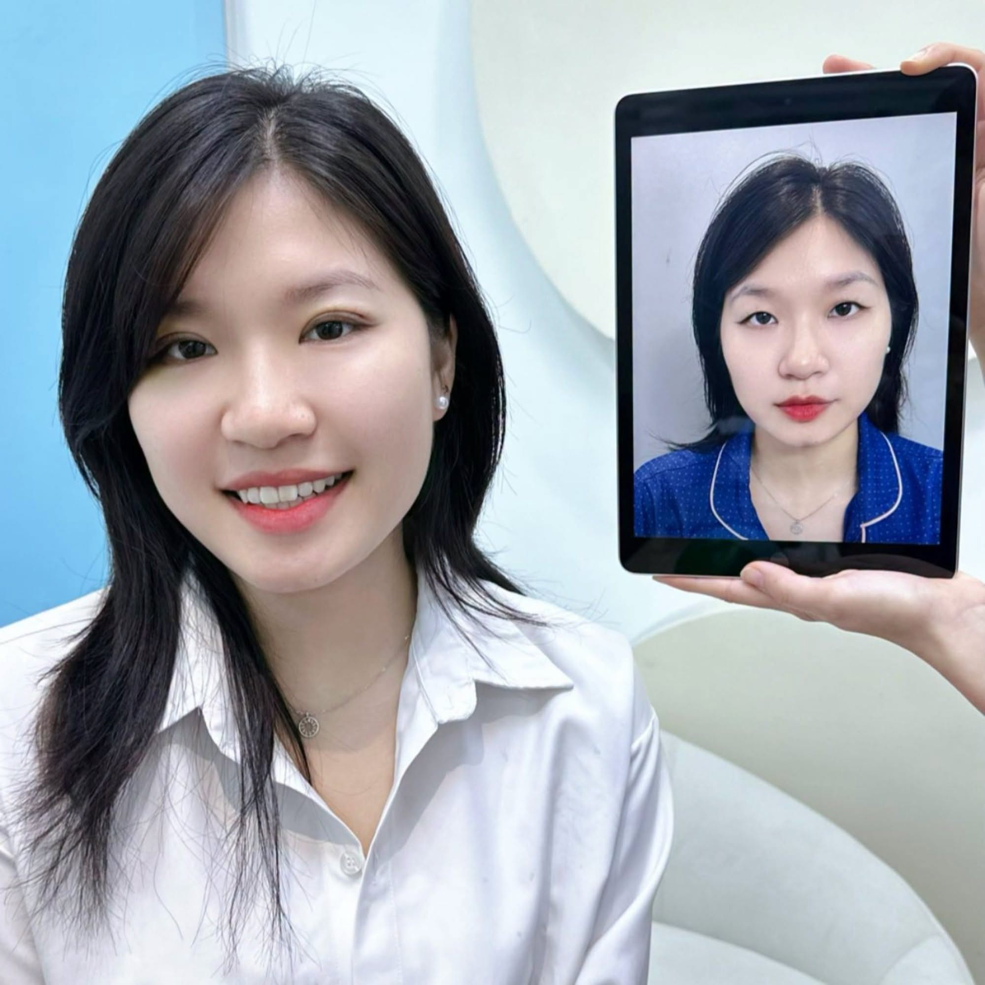 Khách hàng sau chỉnh sửa mí mắt với nếp mí rõ và cân đối hơn so với trước