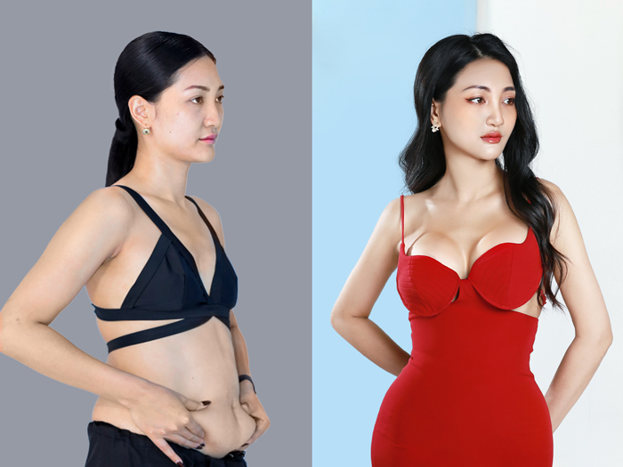 Khách hàng sở hữu vóc dáng thon gọn, cuốn hút sau hút mỡ, nâng ngực