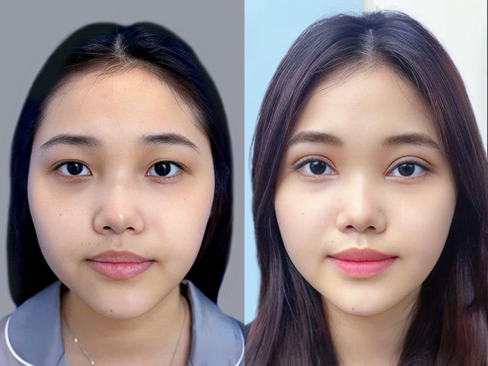 Hình ảnh trước và sau cải thiện sụp mí, cho thấy đôi mắt mở rõ hơn và nếp mí cân đối hơn sau can thiệp.