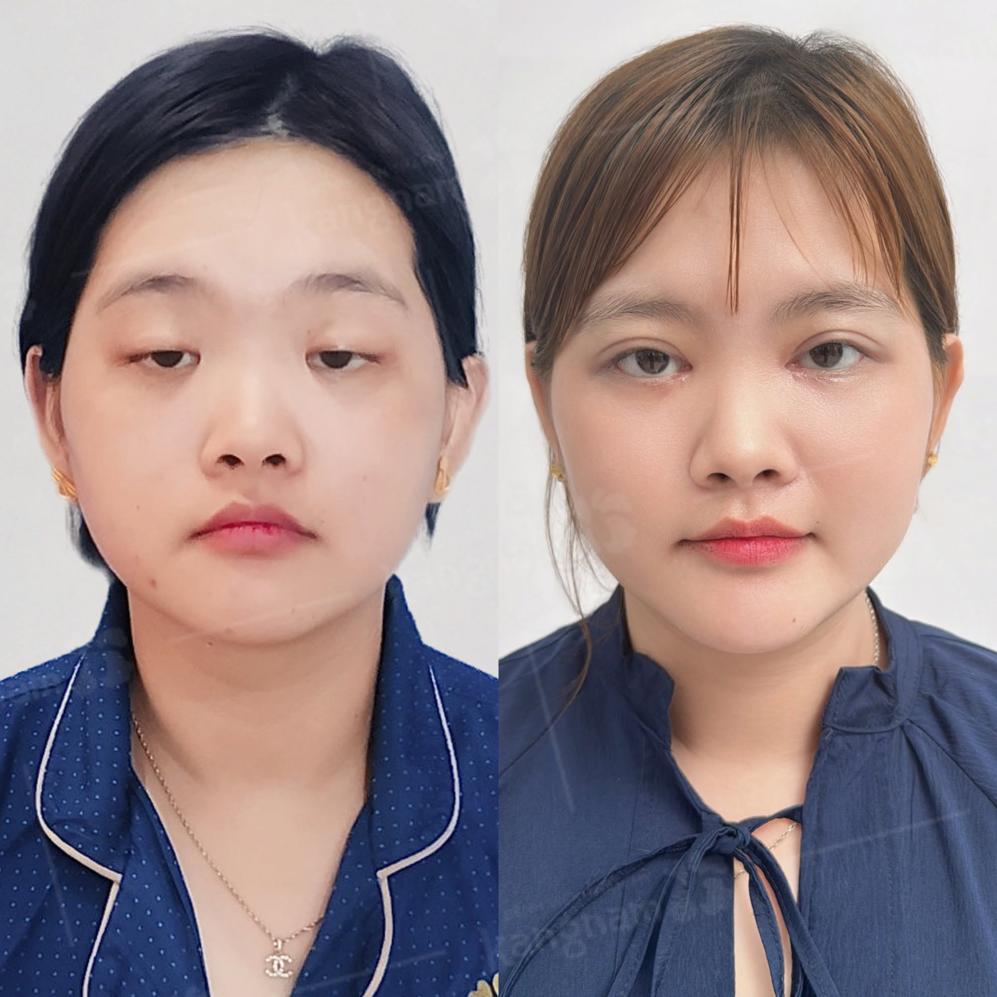 Khách hàng chỉnh hình sụp mi bẩm sinh kết hợp cắt mí