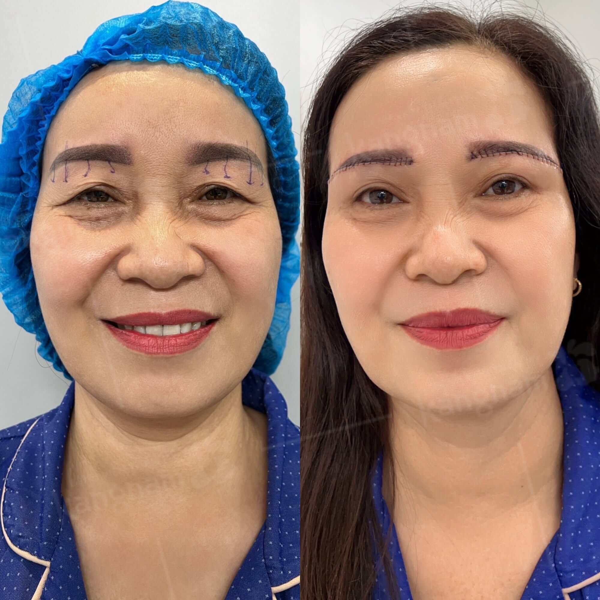 Hình ảnh trước và sau treo chân mày cho thấy cung mày được nâng cao hơn, vùng mí trên gọn và khuôn mặt trông trẻ trung hơn.