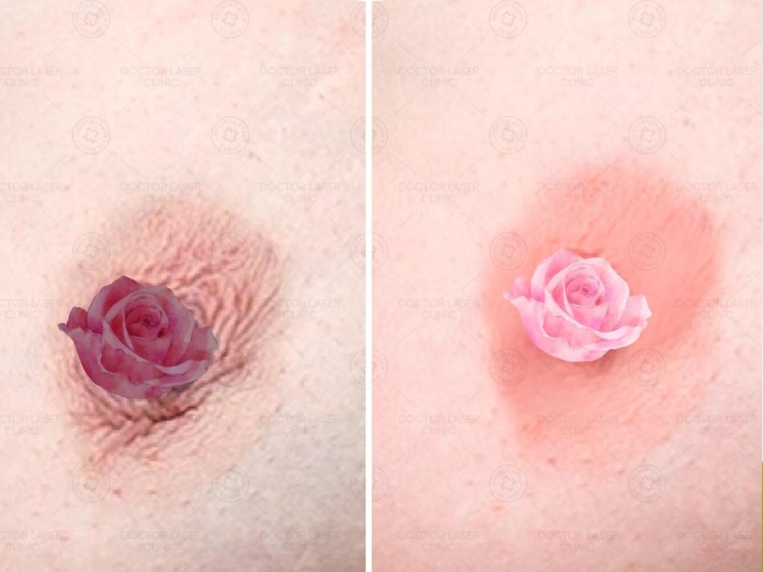 Làm hồng nhũ hoa bằng laser giúp nhũ hoa hồng hào, ảnh so sánh trước sau