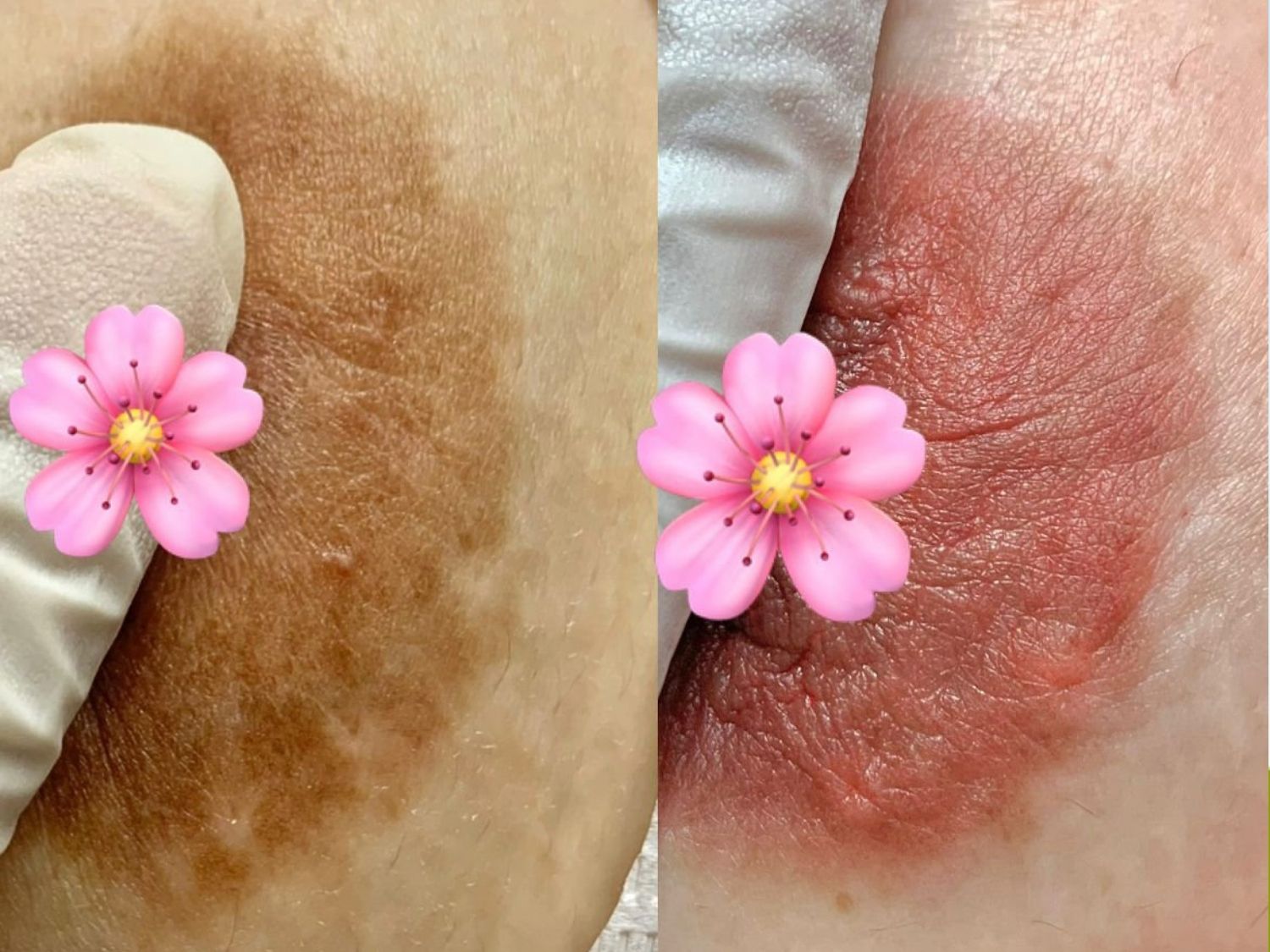 ảnh trước và sau khi làm hồng nhũ hoa của khách Kangnam
