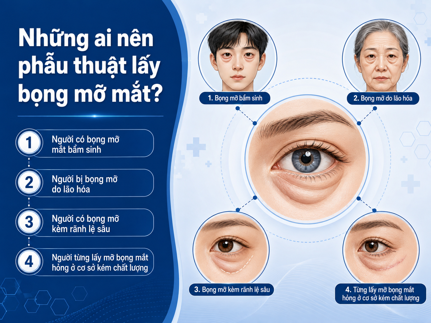 Những trường hợp có bọng mỡ mắt bẩm sinh, do lão hóa