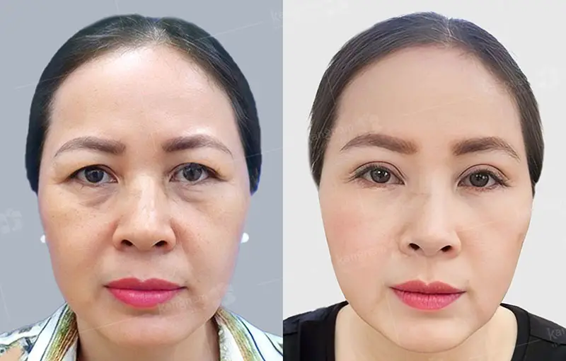 Hình ảnh trước và sau lấy mỡ bọng mắt, vùng mí dưới giảm bọng mỡ và trông gọn gàng hơn sau thực hiện.