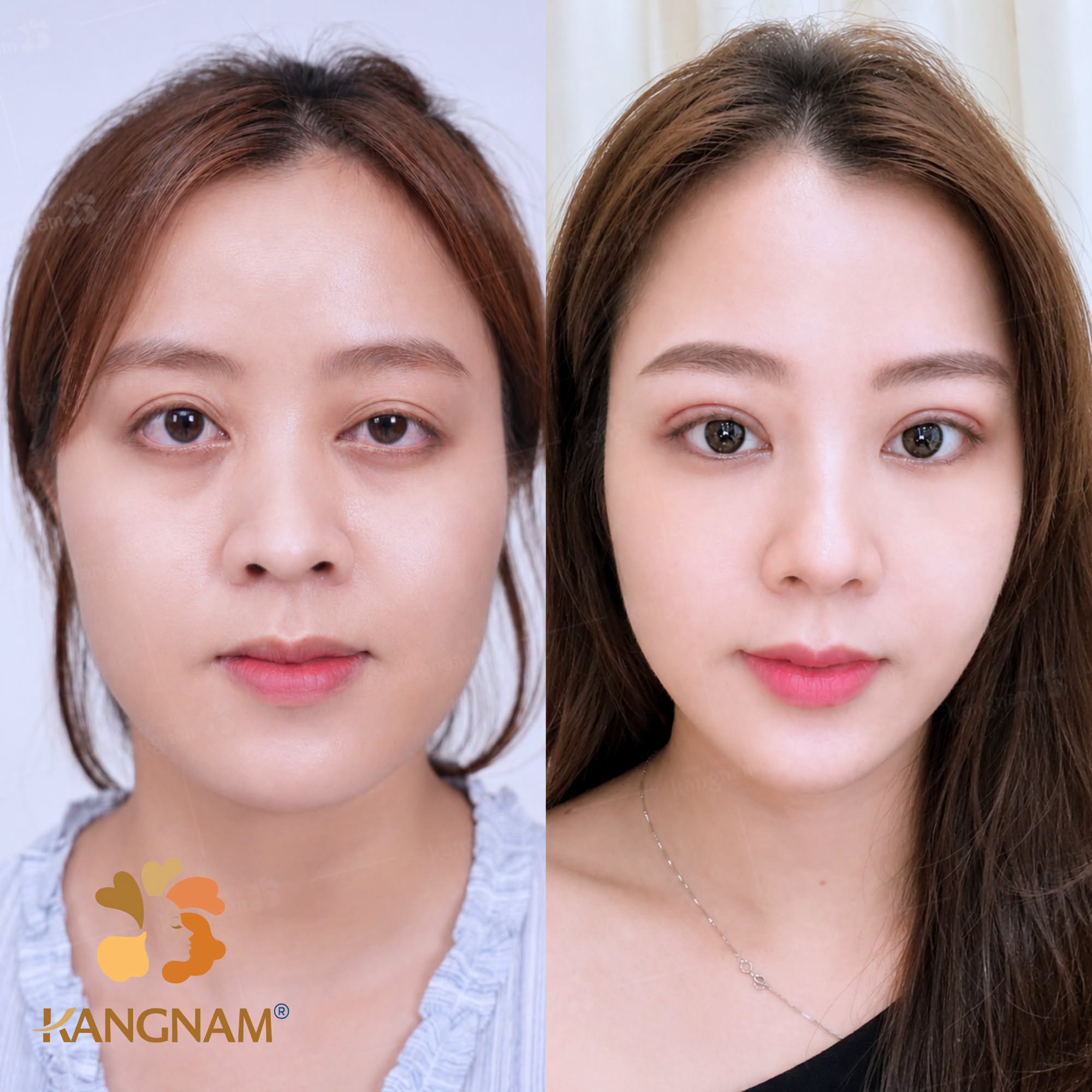 Có thể cắt mí vào bất kỳ thời điểm nào nếu sức khỏe khách hàng đảm bảo