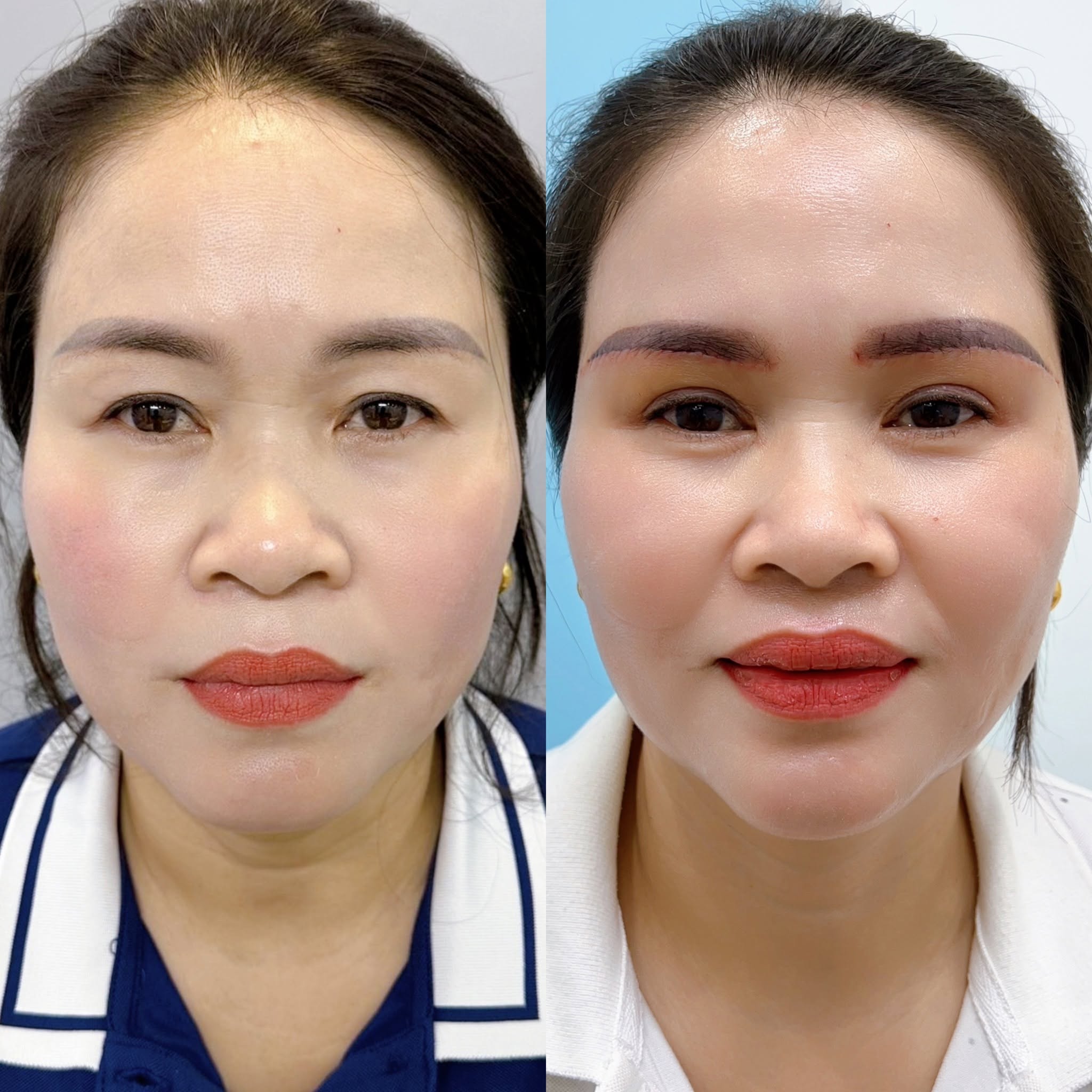 Nâng cung chân mày giúp đưa phần chân mày về đúng vị trí